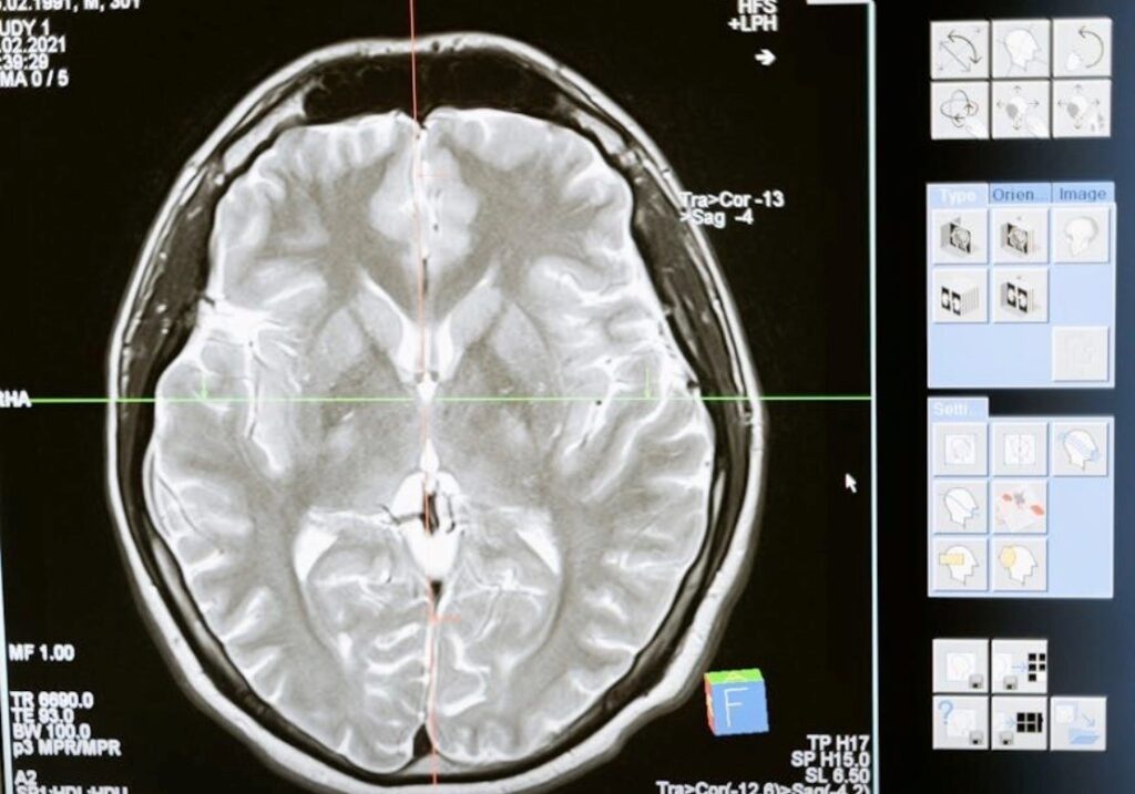 Researchers found that two blood based bio markers -p-tau217 , which reflects Alzheimer's disease proteins in the brain, and GFAP , which reflects brain inflammation were strongly associated with faster loss of memory thinking ability and independence. Researchers found that two blood based bio markers -p-tau217 , which reflects Alzheimer's disease proteins in the brain, and GFAP , which reflects brain inflammation were strongly associated with faster loss of memory thinking ability and independence.